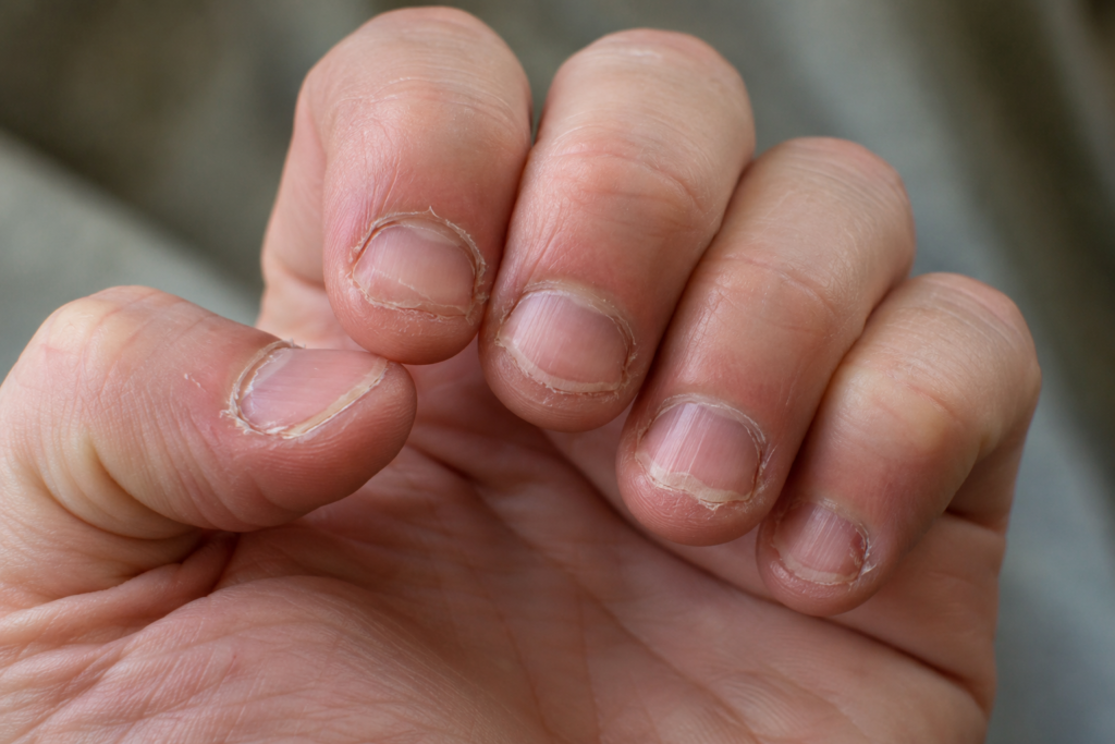 Close-up of nails showing damage from habitual biting