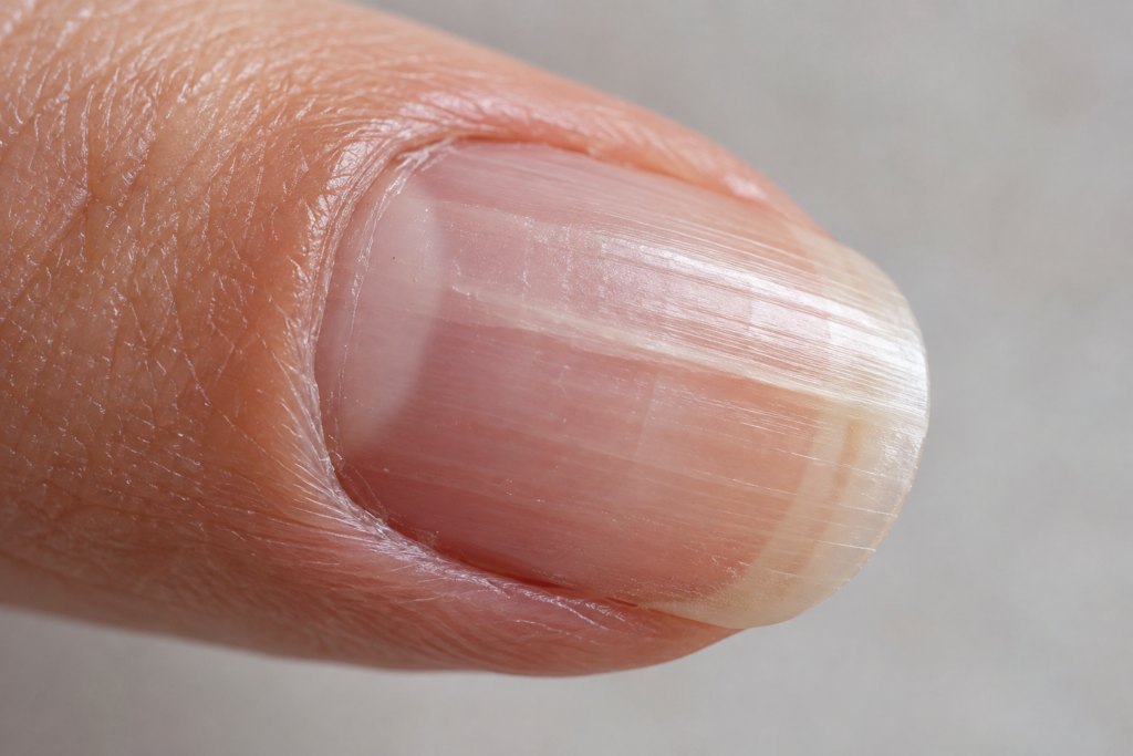 Close-up of a fingernail showing a visible growth line